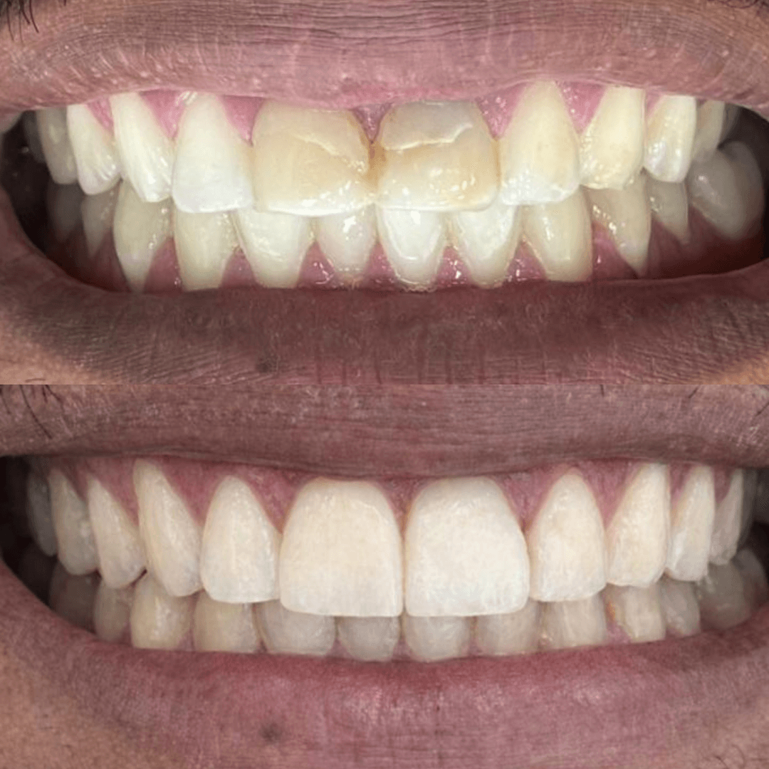 Estética Dental